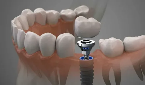 Имплантология